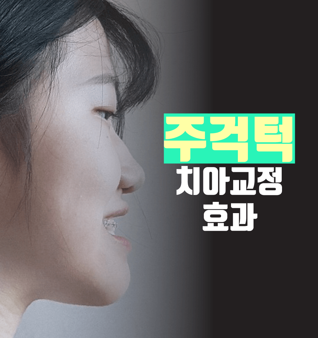 주걱턱-치아교정-효과