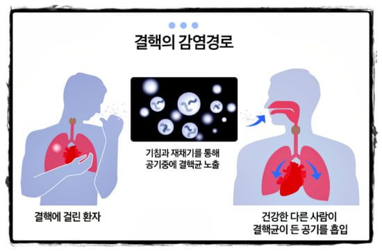 결핵 증상