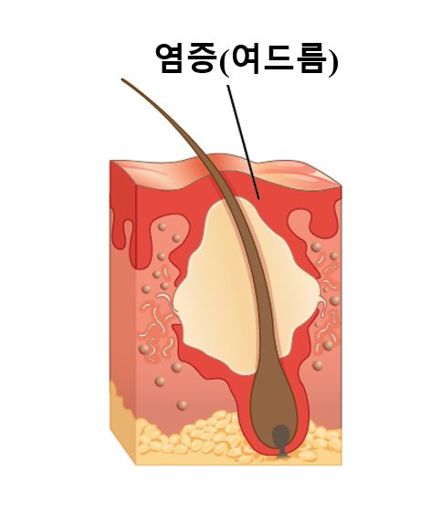 막힌 모공에 여드름이 생긴 그래픽