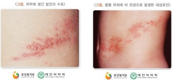  극심한 통증을 동반하는 대상포진(혐짤 주의)