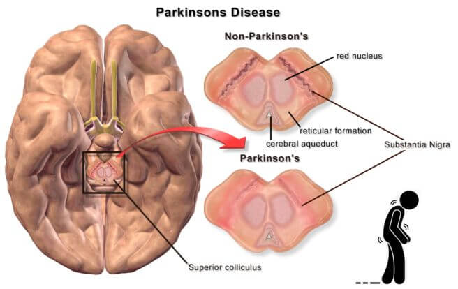 파킨슨병 증상