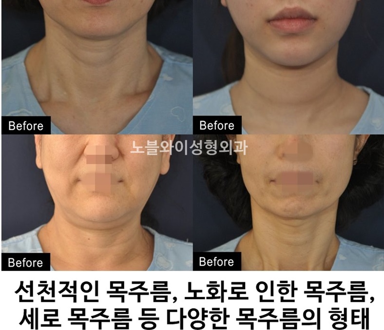  목주름시술비용 아까울수밖에?