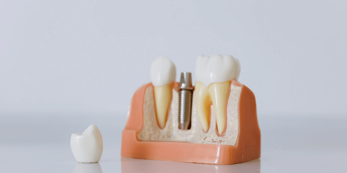 치아 3개 중 중간에 임플란트 모형 사진