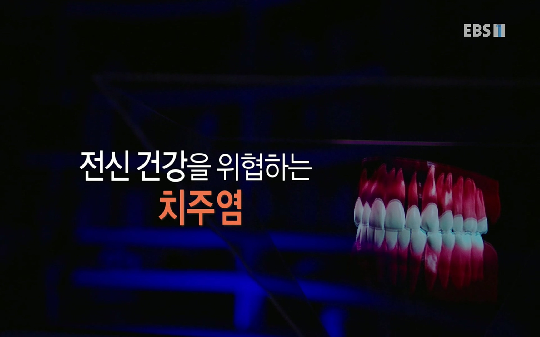 EBS 명의 헬스케어 - TV - 교육의 중심 EBS치주염이 코로나로 소홀해진 구강관리가 치아를 더 망가트리고 위험하게 만들며, 증상이 없기 때문에 특히 더 조심하고 치은염 단계에서 진행되지 않도록 예방해야한다 정의원 교수님과 치_20220505_150516.253.jpg