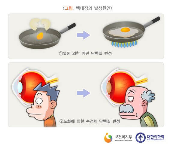 백내장 증상