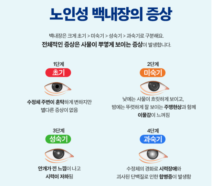 백내장의장상-눈모양
