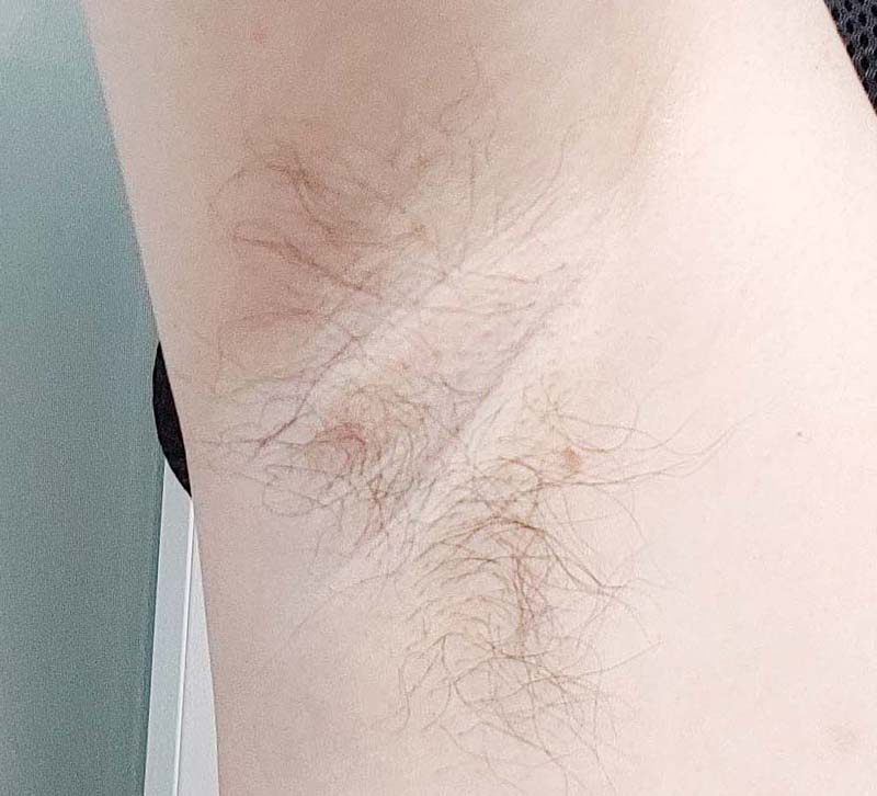  쥐젖 제거방법 및 생기는 이유