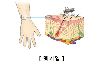 뎅기열 바이러스 감염