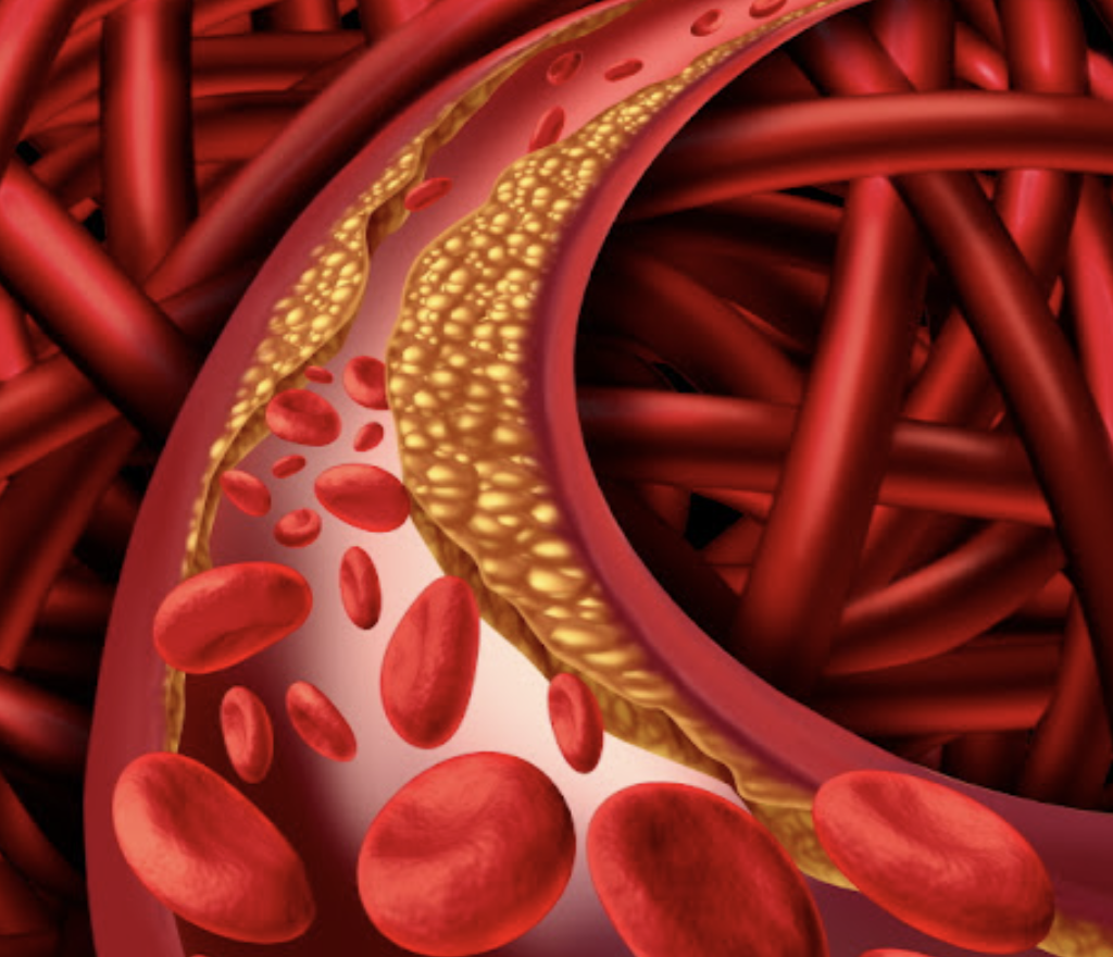 고지혈증 혈관