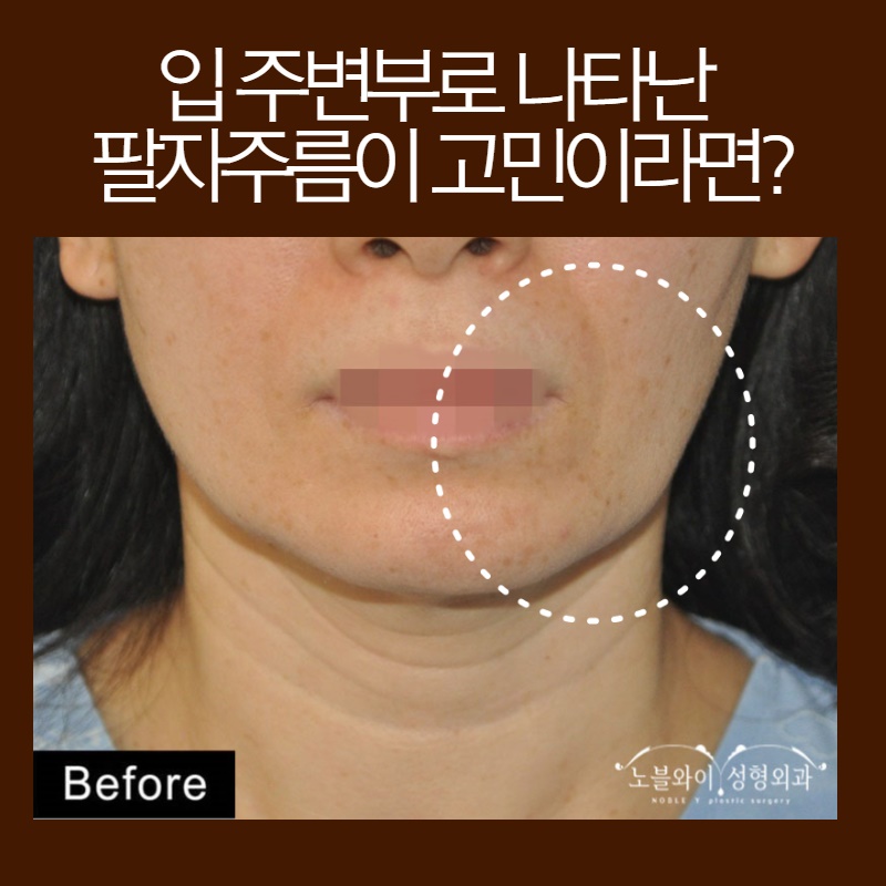  노블와이 팔자주름 안면거상으로 개선될까