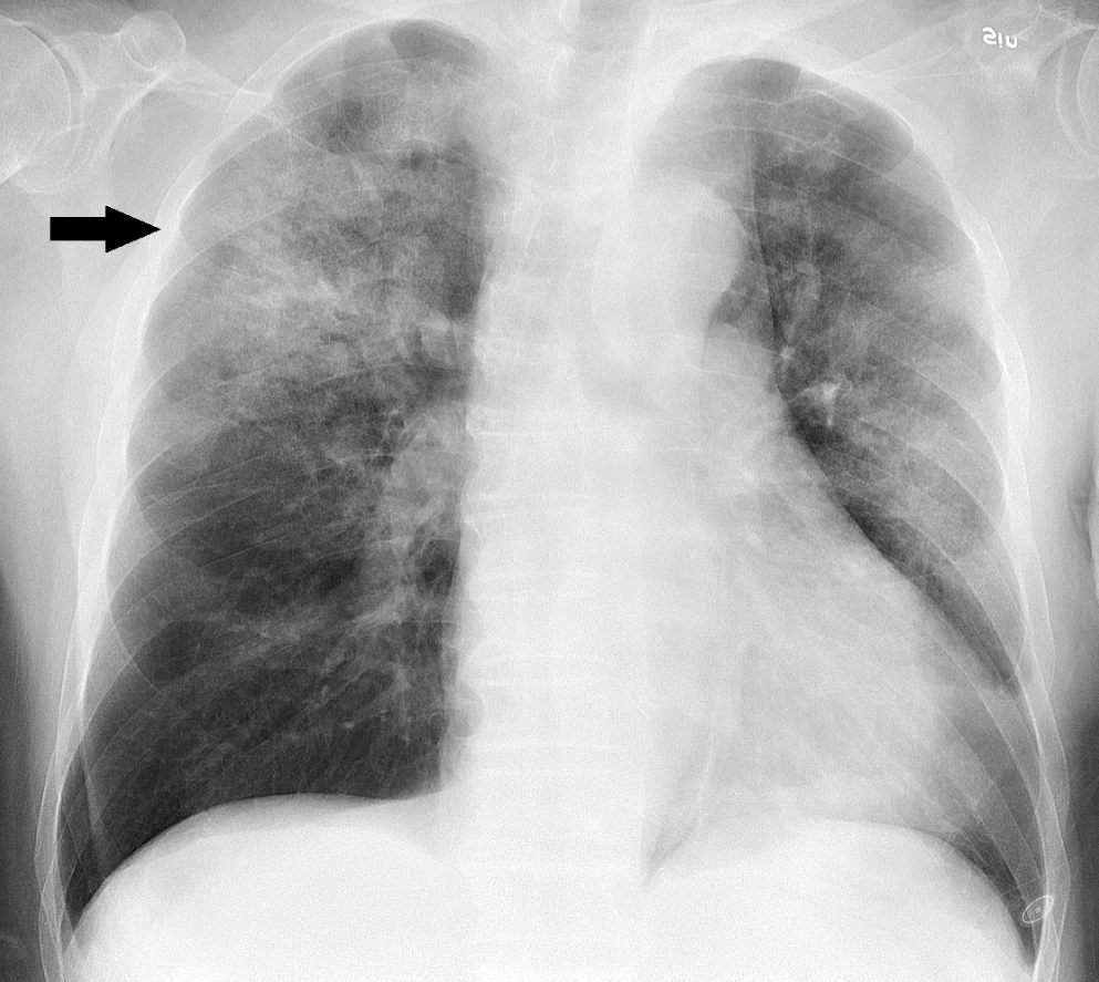 폐렴환자의 폐