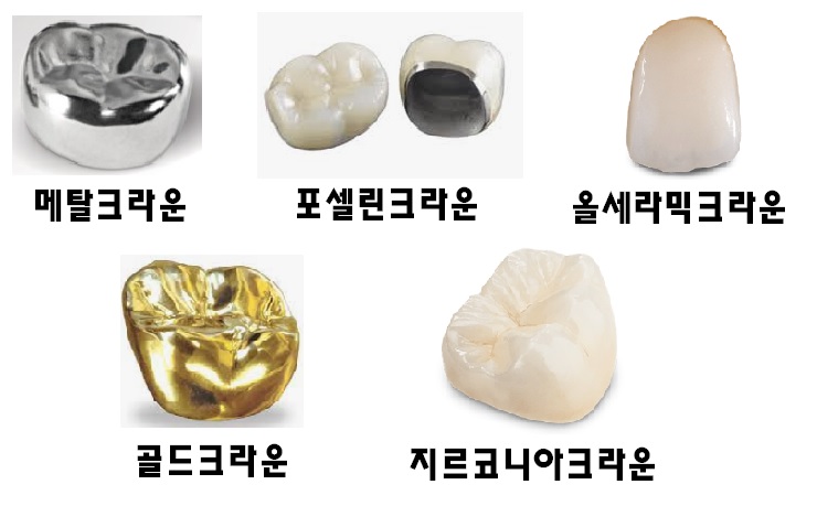 크라운 종류 5가지 사진