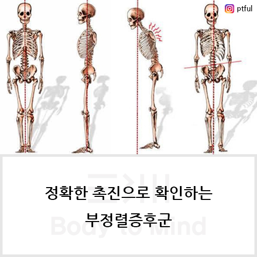  정확한 촉진(palpation)으로 확인하는 부정렬증후군(malalignment syndrome)