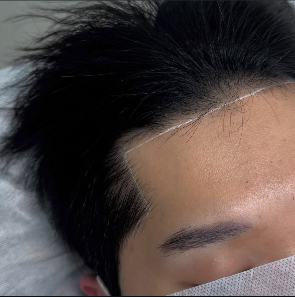 두피문신 부작용