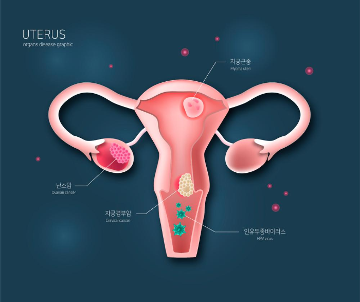 강화군 자궁근종 16년 전 발견 후 방치한 사례