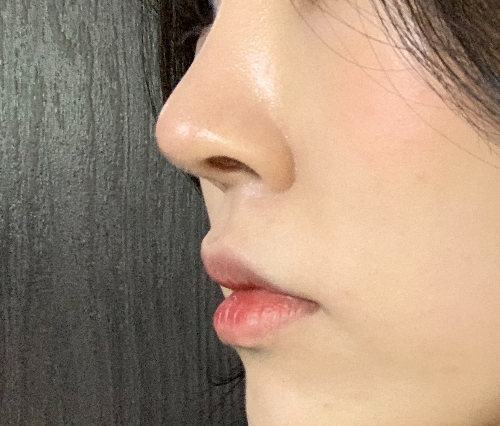 코수술 후 일년 후 지금 모습