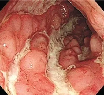 배가 부글부글 설사 원인파악 대처법_21