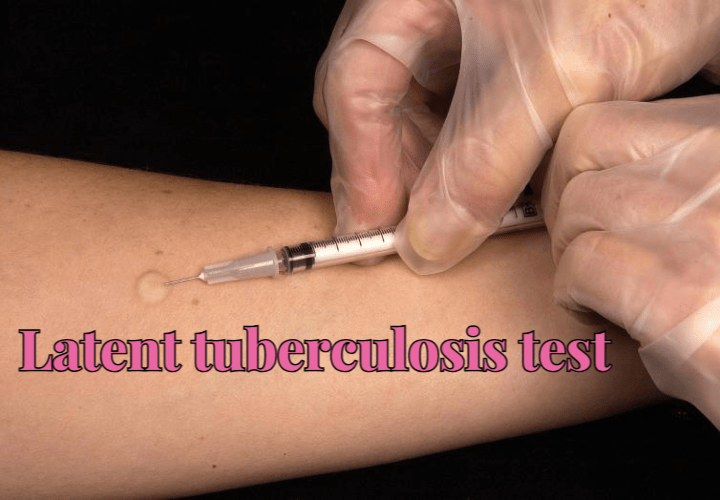 Latent tuberculosis test
