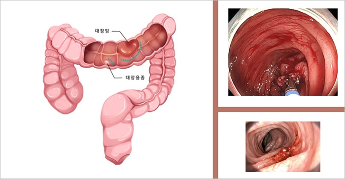 대장과-대장암-사진