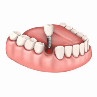 임플란트 가격 종류 비용 시술과정_6