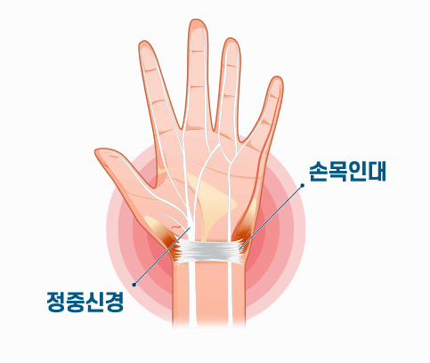 손목터널증후군이란
