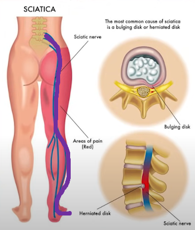  허리디스크 수술 후 1년 재활운동과 풋드랍(족하수) 극복기