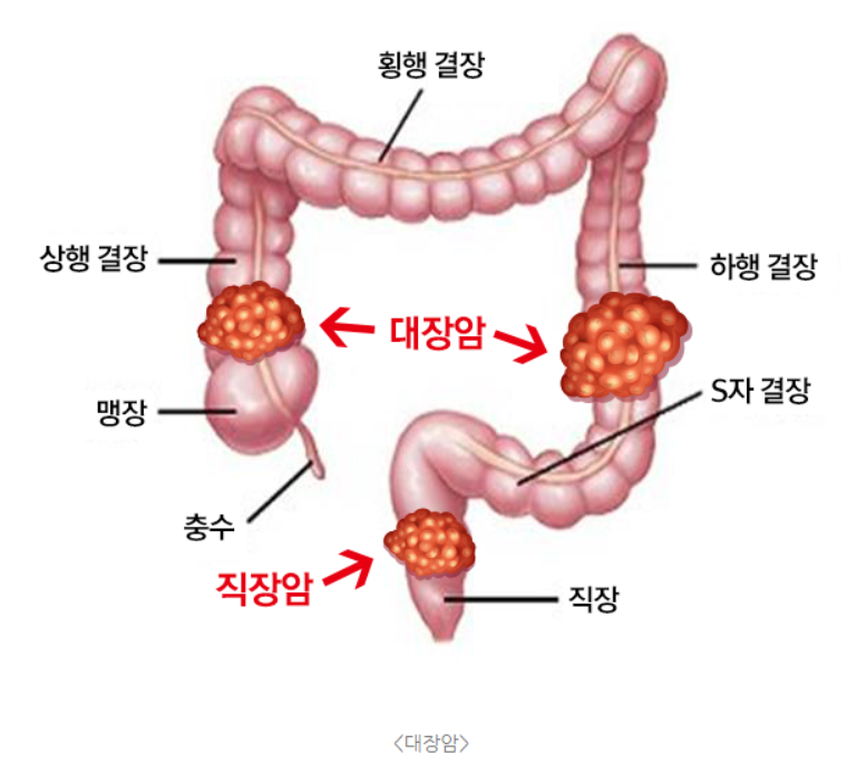 대장암의 위험과 예방법