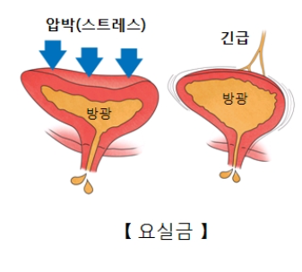 요실금