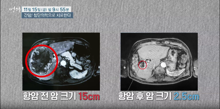 항암전 후
