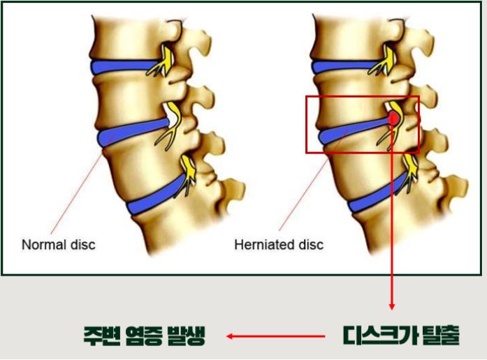 목디스크의 원인