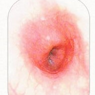  역류성식도염증상과 치료 방법