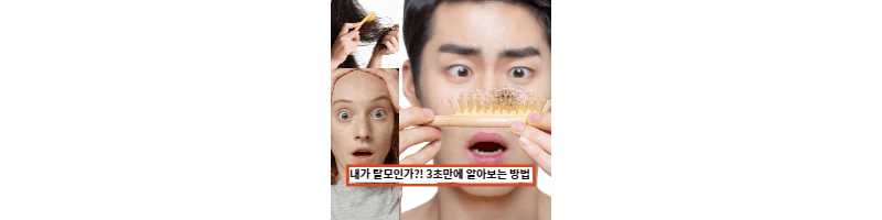  탈모자가진단 방법과 예방법