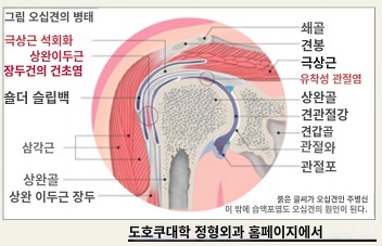  어깨 * 오십견에 대하여 알아보자