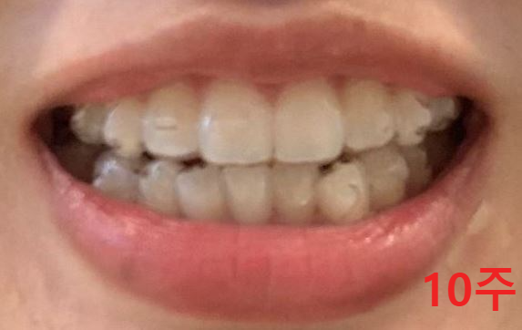 인비절라인-착용-10주-사진