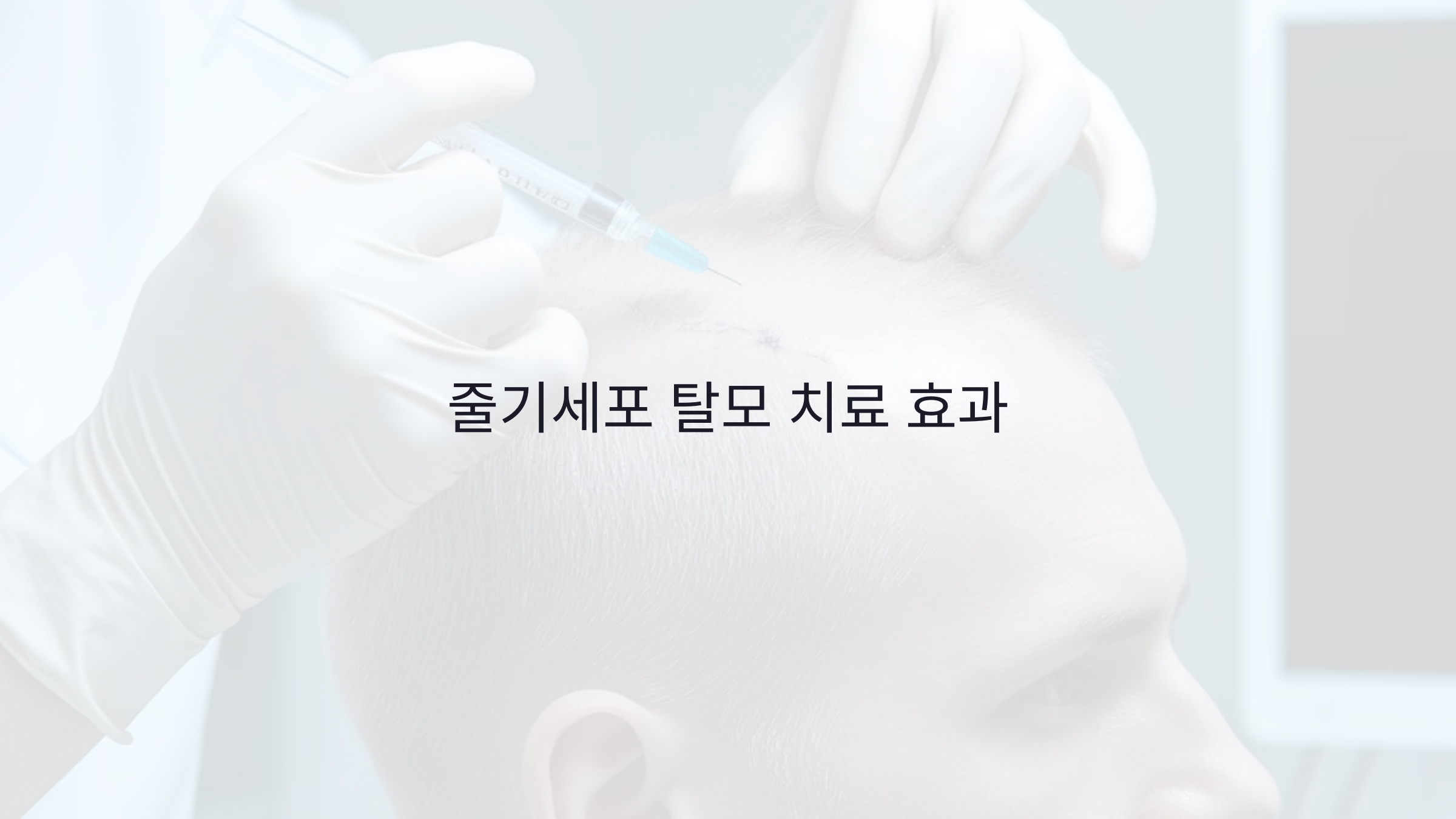 줄기세포 탈모 치료