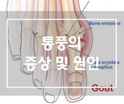 엄지발가락 붓기 문제의 원인에 대해 정중히! 2