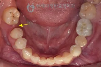 어금니 칫솔 사용법 선택방법 실사용 후기_9