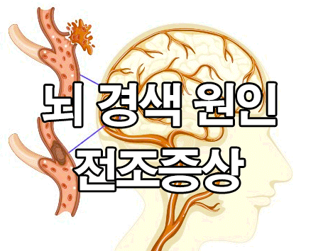  뇌경색 전조증상 및 원인 : 좋은 음식, 후유증
