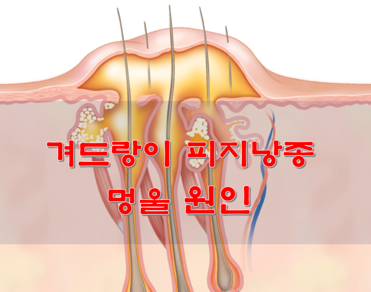  겨드랑이 피지낭종 멍울 원인
