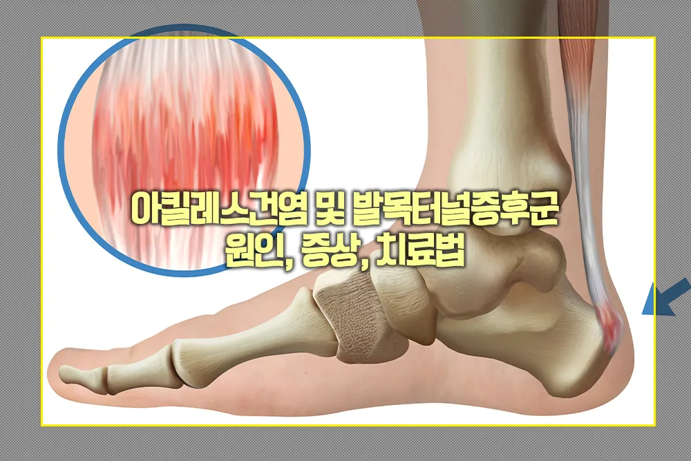 아킬레스건염 발목터널증후군 원인 증상 치료법