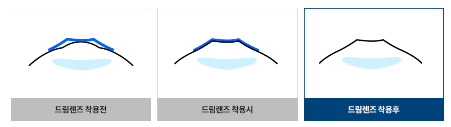 드림렌즈착용후