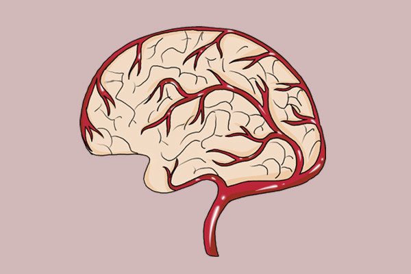 행복하데이 :: 뇌경색 초기증상 전조증상 체크