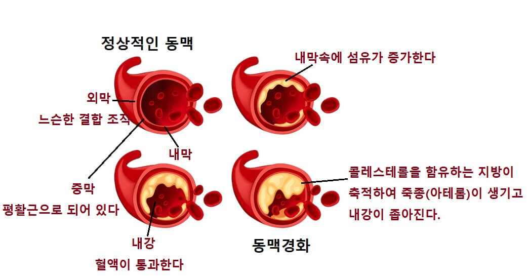  혈압 낮추고 싶다면? 콜레스테롤 낮추고 싶다면? 혈압과 콜레스테롤.