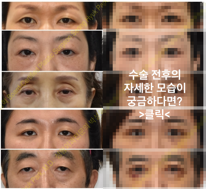 눈매교정-안검하수
