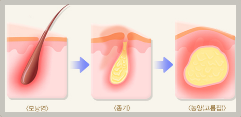 엉덩이 종기 원인&#44; 증상&#44; 치료법&#44; 예방법 알아보기