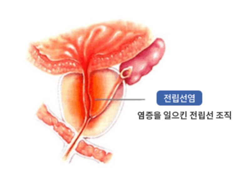 전립선염 원인