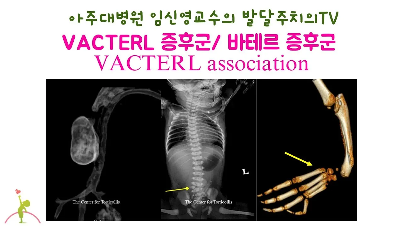 바테르증후군 원인 증상 치료법_1