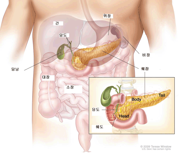 췌장암 초기증상 설명