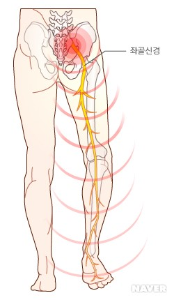 좌골신경통