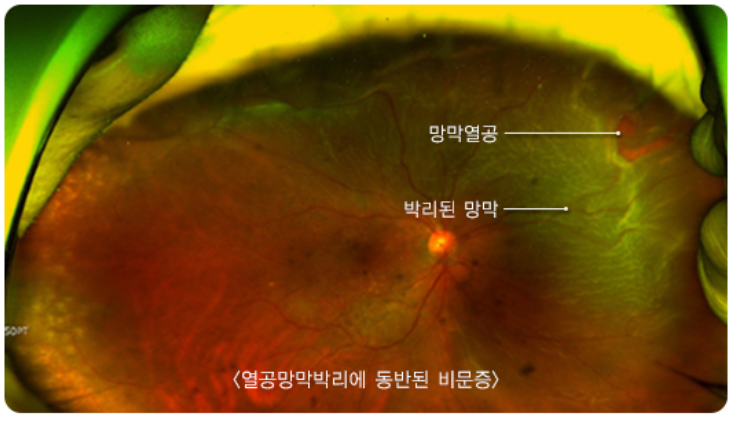 비문증 자연치료 5